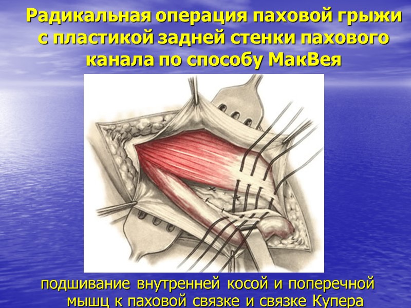 Радикальная операция паховой грыжи с пластикой задней стенки пахового канала по способу МакВея 